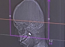 مستشفى رمبام حيفا: نجاح عملية جراحية معقدة لاستخراج رصاصة من رأس طفل (11 عاماً)