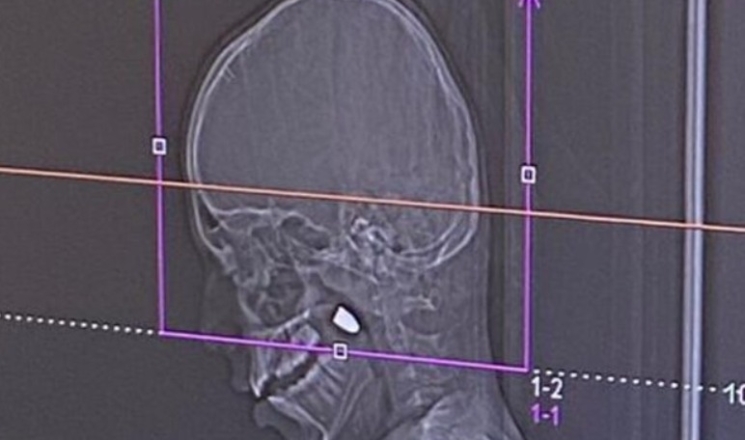 مستشفى رمبام حيفا: نجاح عملية جراحية معقدة لاستخراج رصاصة من رأس طفل (11 عاماً)