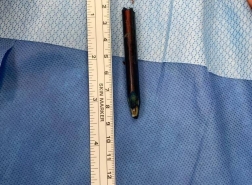 اخراج جزء من قلم رصاص من منطقة قريبة من مؤخرة فتى!