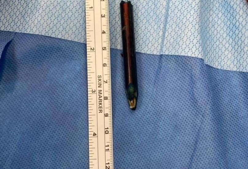 اخراج جزء من قلم رصاص من منطقة قريبة من مؤخرة فتى!